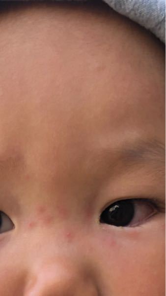 2歳の子供なのですが 保育園帰って来た頃から 目の腫れ 目やに 眉 Yahoo 知恵袋