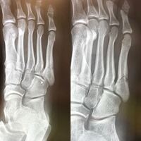 5月29日に第5中足骨骨折をしました 最初はシーネ 固 Yahoo 知恵袋