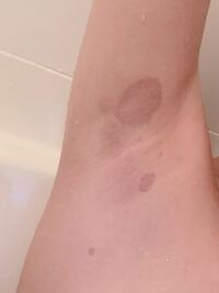 1年前から脇の下に薄茶色のシミができていたんですが あまり気 Yahoo 知恵袋