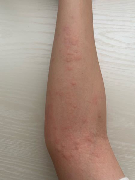 皮膚の病気 アトピー 解決済みの質問 Yahoo 知恵袋