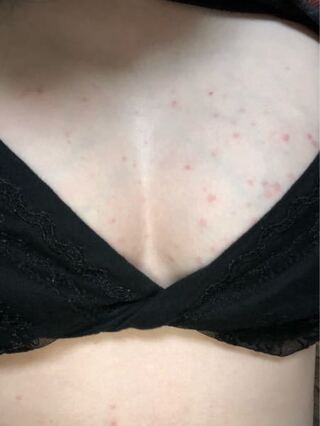 一週間ほど前から胸全体にこのような湿疹ができすごく痒いです 市販 Yahoo 知恵袋