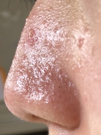 鼻がボコボコしています 多分 詰まった角栓を爪で無理やり取っ Yahoo 知恵袋