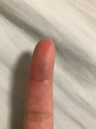 イライラして壁を殴ったら人差し指の腹が凄く腫れてました 骨折でしょうか Yahoo 知恵袋