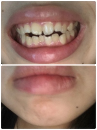 口ゴボ アデノイド顔貌 梅干し状のしわの解消方法を教えて下さい 250 Yahoo 知恵袋