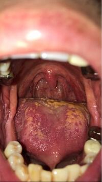 舌がヒリヒリして痛くて味が無いです 元々は喉が可笑しく痰が絡んで Yahoo 知恵袋