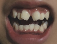 閲覧注意 18歳女子です小さい頃から歯並びの悪さがコンプレ Yahoo 知恵袋