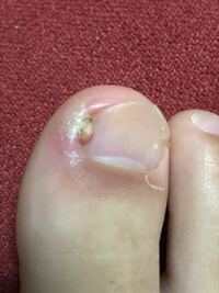 ひょうそになって肉芽ができて 液体窒素をして痛みがなくなりま Yahoo 知恵袋
