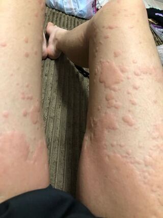 3 歳児 蕁 麻疹 500以上の最高の文字の引用画像