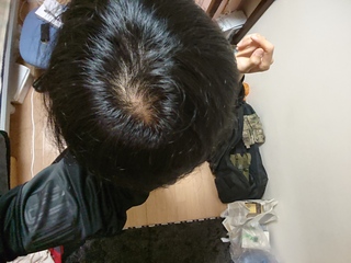 つむじハゲかどうか教えてください このようなつむじの写真でハゲ薄毛 Yahoo 知恵袋