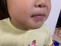 質問です ご飯後に娘の唇の周りが紫色になっているのです Yahoo 知恵袋