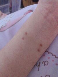 リストピアスを数ヶ月前に排除して この排除跡 が一切消えません Yahoo 知恵袋