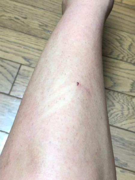 高校1年男子です この前初めてすね毛を髭剃り用のカミソリ Yahoo 知恵袋