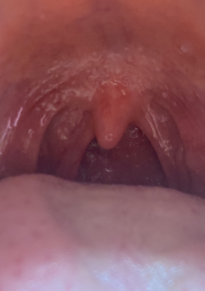 扁桃腺が炎症を起こしていますか？それとも正常ですか？扁桃腺炎 