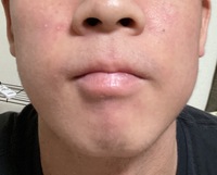 全身のアトピー持ちです 顔の赤みや炎症が中々消えなくて悩んで Yahoo 知恵袋