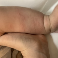生後4ヶ月の赤ちゃんです 足のすねより下 足首付近 に 湿疹ができたの Yahoo 知恵袋