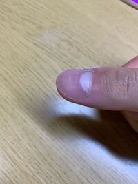 親指の爪だけ横に線があるのですがこれはなぜでしょうか 両方の Yahoo 知恵袋