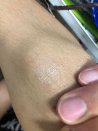 自転車でこけて膝を怪我してしまったんですけど そのあと膝の傷は治ったん Yahoo 知恵袋