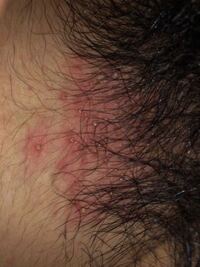 陰毛らへんが痒くなりこれでもかって程掻いた2 3日後に画像のような膿み Yahoo 知恵袋