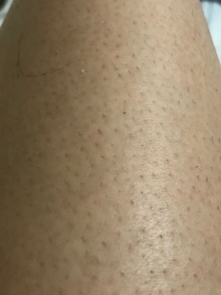 皮膚の病気 アトピー 解決済みの質問 Yahoo 知恵袋