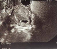 5w4dで胎嚢確認できました 大きさは聞いてなくてエコー写真 Yahoo 知恵袋