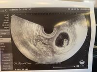 エコー写真についてです 現在9w1dの妊婦なのですが7 Yahoo 知恵袋