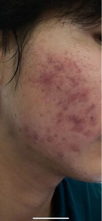 ニキビ ニキビ跡が酷いです ニキビ跡を治している段階で最近またニキビが Yahoo 知恵袋