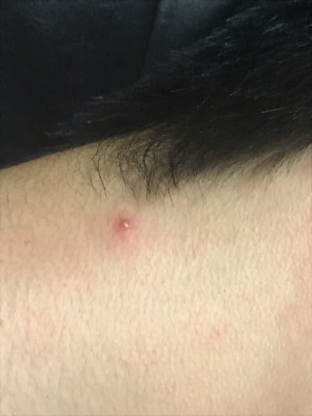 首の右後ろにしこりがあるのですが、これは何でしょうか。虫刺さ 
