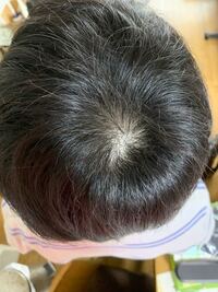 つむじ はげかけてますよね 今からできる対策を教えてください 24歳 Yahoo 知恵袋