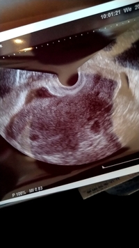 妊娠5週です エコー写真ですが 双子でしょうか Yahoo 知恵袋