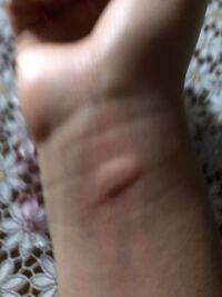 うさぎに噛まれるといつもこうなります バイ菌ですか Yahoo 知恵袋