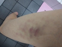 あざについて質問です 今日の朝には無かったんですが太ももに赤 Yahoo 知恵袋