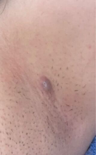 脇の下 でき もの 痛い