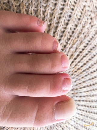 足の指が痛いです 人差し指の左側の皮膚が少し腫れていてすごく痛いです Yahoo 知恵袋
