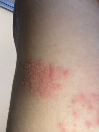 体の側面で 脇の下胸の横 ブラよりは上の位置に 写真のようなブツブ Yahoo 知恵袋