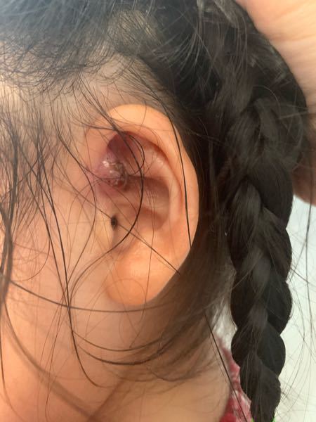 先天性耳瘻孔 手術 に関するq A Yahoo 知恵袋