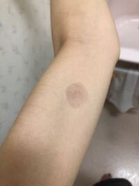市販のヘアカラーのパッチテストをやったら5分くらいしか経って Yahoo 知恵袋