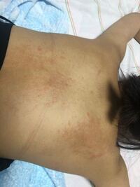 見苦しくてすみません 背中の汗疹がなかなか治らないのですけど Yahoo 知恵袋
