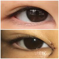 先日目頭切開しました 糸が入っているせいかおかしく感じま Yahoo 知恵袋