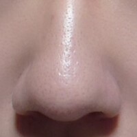 ひどい写真ですいません 団子鼻を自力で治すことはできますか Yahoo 知恵袋