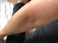 何気なく痒いたり 刺激でミミズ腫れができます 腕に限らず身体中 顔にも Yahoo 知恵袋