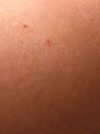 腕に二箇所赤い斑点みたいになっているのですが これは虫刺されですか Yahoo 知恵袋