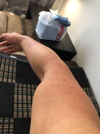閲覧注意昨日から腕に痒みがではじめて次の日には蕁麻疹のような出来物が腕 Yahoo 知恵袋