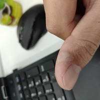 手持ち花火で指を火傷し 水ぶくれができ 色が白くなりました 痛みはない Yahoo 知恵袋
