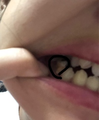 子どもの歯茎が腫れている 子どもも歯周病になるの 若林歯科医院に聞きました