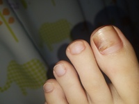 足の親指の爪が変色しています 特に痛みなどはなくある日突然なっていまし Yahoo 知恵袋