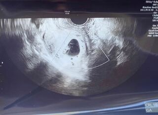 7週4日 およそ のエコー写真です 無事 胎芽も心拍も Yahoo 知恵袋