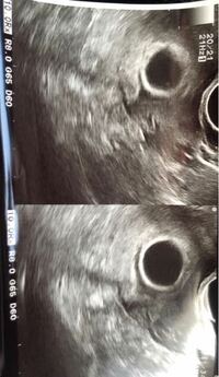 妊娠7週3日目の妊婦です稽留流産について エコー写真 Yahoo 知恵袋