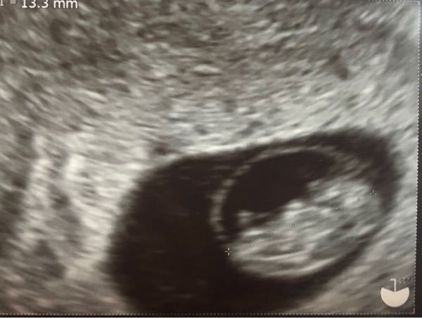 エコー写真なんですが、赤ちゃんの周りの輪っかのようなものは何 