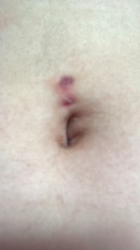 汚い写真です 閲覧注意 へそピアスが半年ほど経っても安定しないのでフ Yahoo 知恵袋