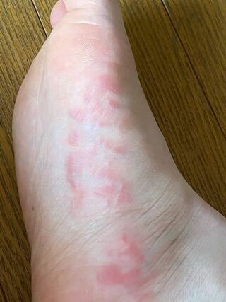 足 赤い 斑点 足に赤い斑点があるけどかゆくない原因は 何かの病気